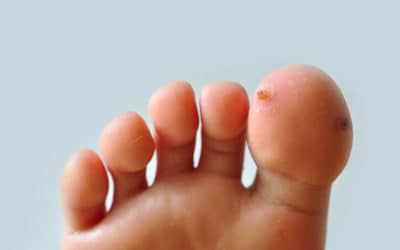 Get Rid of Foot Warts Fast with Swift