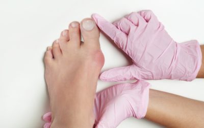 What Treating a Bunion is All About